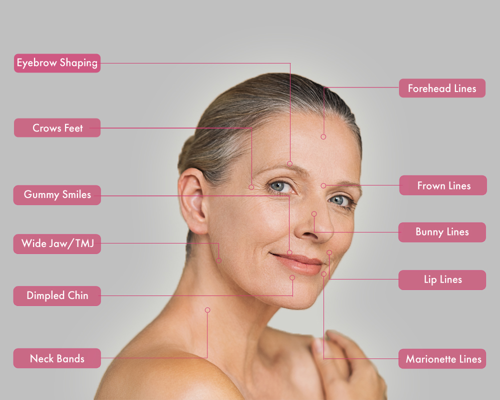 Botulinum toxins such as BOTOX® are used to treat many areas of the face, as seen in this image.