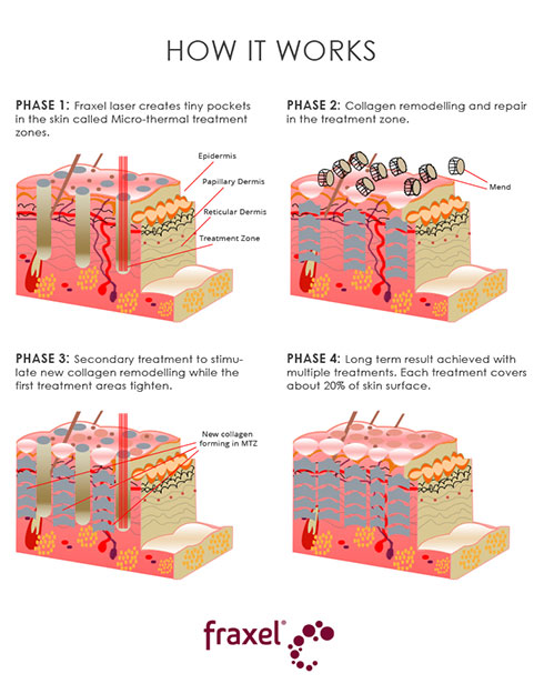 fraxel-laser-working