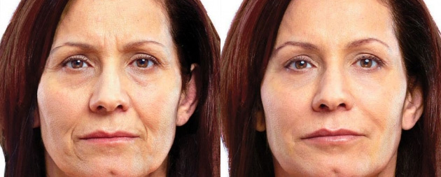 juvederm-voluma-b-a