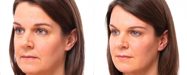 juvederm-voluma-b-a1