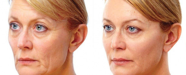 juvederm-voluma-b-a2