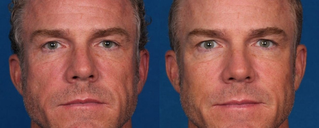 juvederm-voluma-b-a3