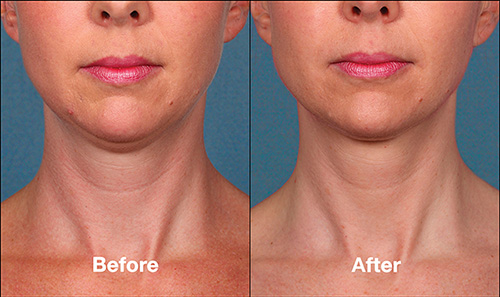 kybella-ba-p1-img1