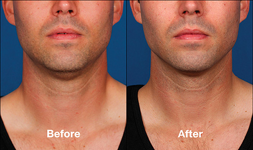 kybella-ba-p2-img1