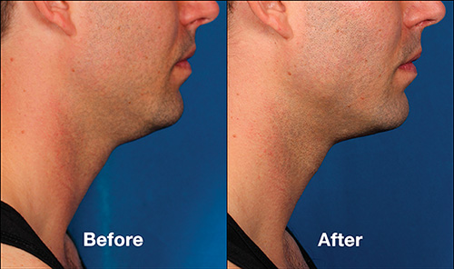 kybella-ba-p2-img2