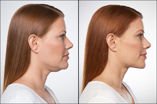 kybella-ba-p9